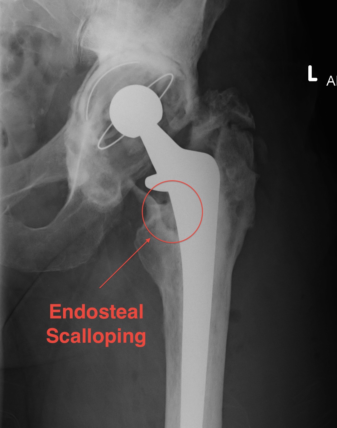 Infected THR Endosteal Scalloping